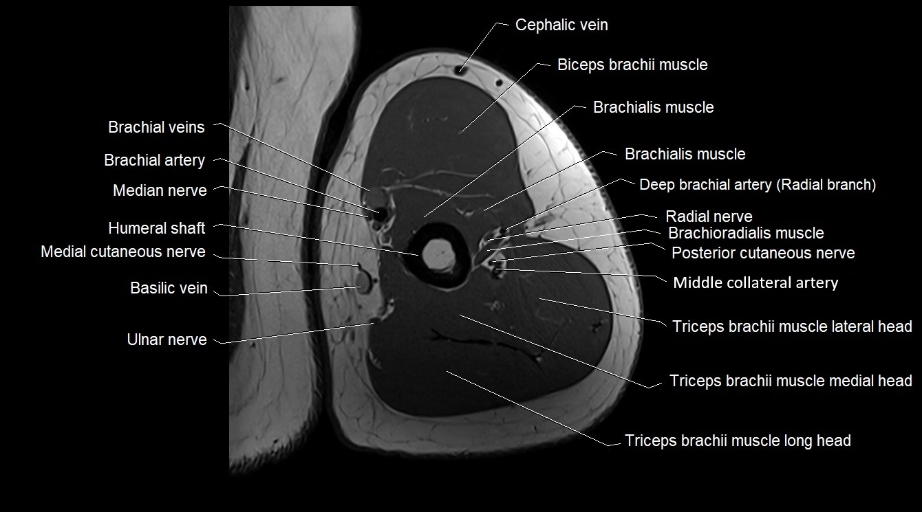 Upper arm( humerus) cross section anatomy MRI 3T axial image 39.webp